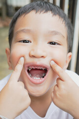 This boy lost his teeth from eating sweets and nibbles, which is likely due to natural loss. His smile reveals gaps where teeth used to be, giving him an attractive, young, and cheerful appearance.