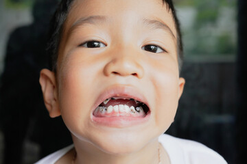 This boy lost his teeth from eating sweets and nibbles, which is likely due to natural loss. His smile reveals gaps where teeth used to be, giving him an attractive, young, and cheerful appearance.