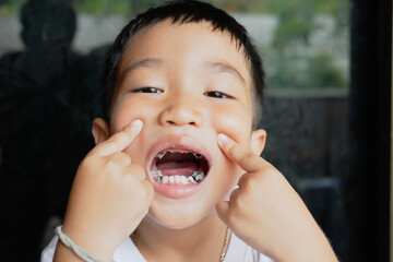 This boy lost his teeth from eating sweets and nibbles, which is likely due to natural loss. His smile reveals gaps where teeth used to be, giving him an attractive, young, and cheerful appearance.