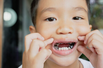 This boy lost his teeth from eating sweets and nibbles, which is likely due to natural loss. His...