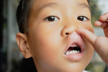 This boy lost his teeth from eating sweets and nibbles, which is likely due to natural loss. His...
