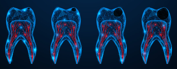 Caries, stages of tooth decay. Low-poly design of lines and dots. Blue background.