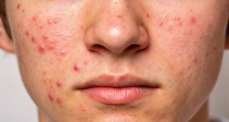 Obraz premium Dermatology Acne Solutions Concept. Skincare solutions for acne treatment include expert consultation and medical expertise in dermatology