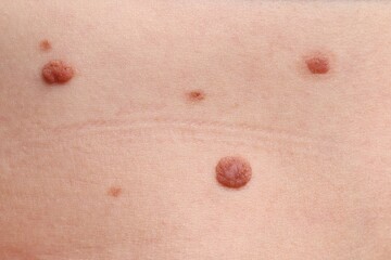 Woman with moles on her body, closeup