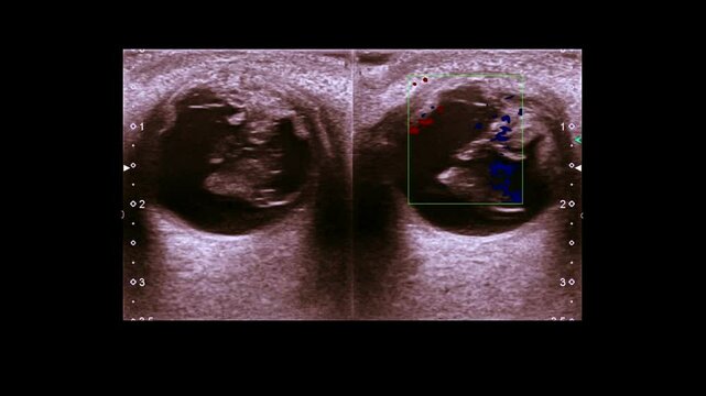 Globe rupture, orbita traumatic, USG ,ultrasound image 
Globe rupture, orbita traumatic, USG ,ultrasound image ,showing collapsed anterior chamber, disruption of the eyeball (bulbus occuli), and vitr
