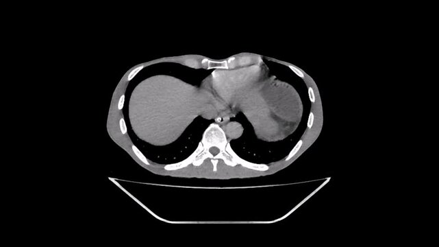 Ileus , small bowel obstruction, abdomen ct scan showing Dilated small bowel loops and multiple air-fluid levels Ileus , small bowel obstruction, abdomen ct scan
