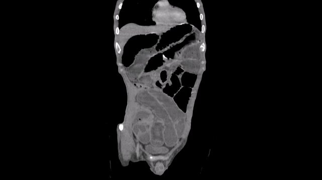 Ileus , small bowel obstruction, abdomen ct scan showing Dilated small bowel loops and multiple air-fluid levels
Ileus , small bowel obstruction, abdomen ct scan 
