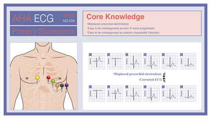 When the electrodes in the chest lead are placed incorrectly, the wrong amplitude evolution of R wave and S wave will occur, which is easy to be misdiagnosed as poor increase of R wave or old AMI.
