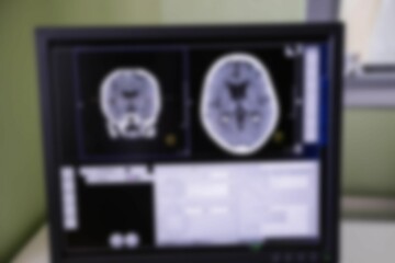 Digital brain scan on computer monitor