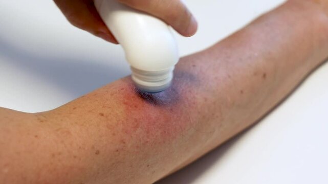 虫に刺された腕に薬を塗る