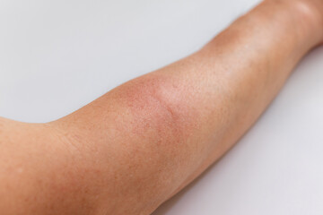 虫に刺されて赤く腫れた腕