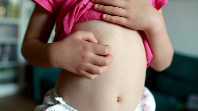 A little girl suffering from chickenpox scratches her belly.