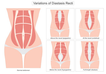 Diastasis recti is a condition where the rectus abdominis the six-pack muscles separate along.