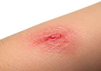 Fototapeta premium Closeup of a Minor Skin Abrasion Redness Inflammation and Healing Process isolated on transparent baackground