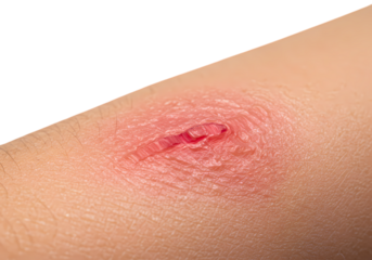 Closeup of a Minor Skin Abrasion Redness Inflammation and Healing Process isolated on transparent baackground