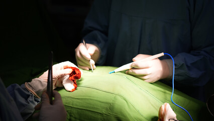 Medical Team Operating on Patient in Hospital Surgical Room Close up View