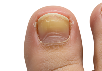 Yellowed and Thickened Toenail A Closeup View isolated on transparent baackground