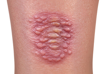 Closeup of Verruca Vulgaris isolated on transparent baackground