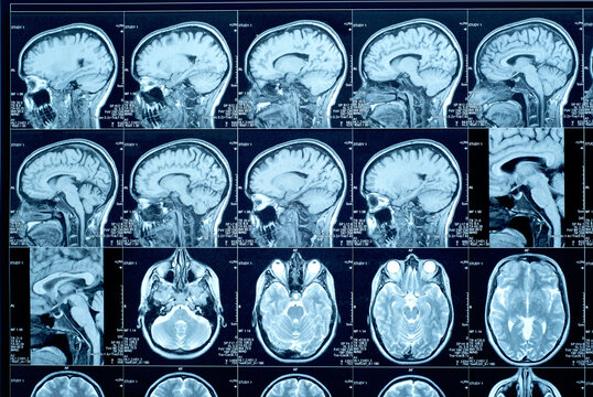 Closeup of a CT scan with brain. Magnetic resonance imaging. Medical, science and education mri brain background. Magnetic resonance imaging.
