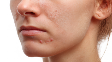 Close up of a woman's face highlighting cystic acne breakouts on her jawline, presented on a transparent background for easy integration into various projects