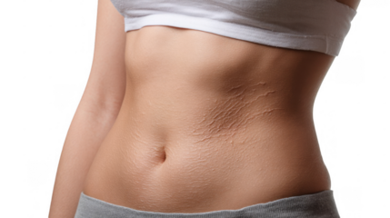 Close up view of a female abdomen featuring stretch marks, emphasizing a prevalent skin condition affecting many individuals, set against a transparent background