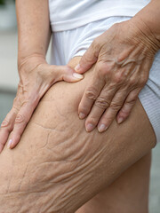 Mature woman inspecting loose thigh skin and cellulite folds