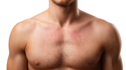 Fototapeta premium Close up of a male chest exhibiting symptoms of a skin allergy, such as redness and small bumps, against a transparent background, emphasizing the visibility of the skin condition