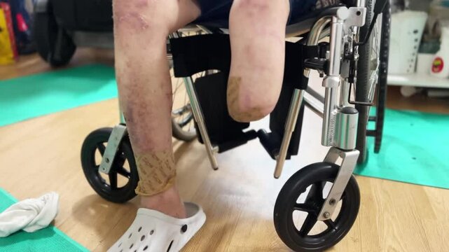 a person whose leg has been amputated due to diabetes
