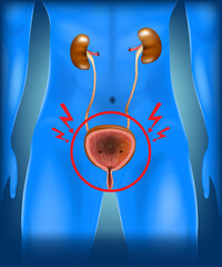 Medical Diagram of Human Kidneys and Inflamed Bladder. Urinary Tract Anatomy with Cystitis Symptoms Highlighted. Bladder Infection 