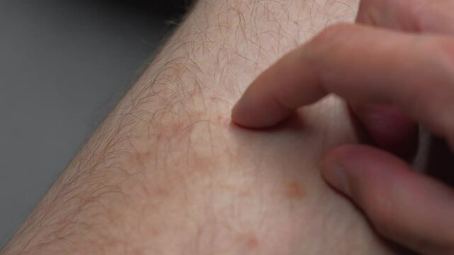 Rash and allergy on a man's leg close-up.
A man touches pimples and wounds on his legs.
A man scratched his leg until it bled.
A torn pimple on his leg macro video