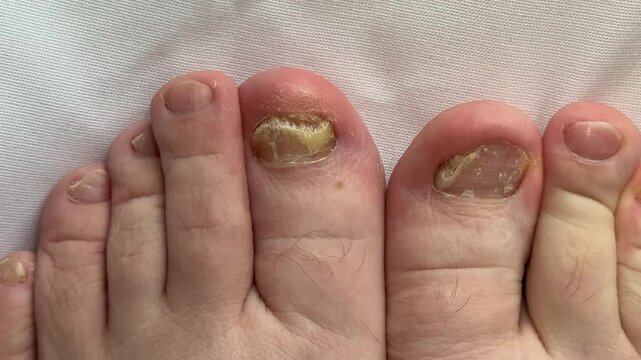 Onychomycosis. A dangerous fungal infection of human toenails. Disease and detachment of the nail plate. Difficult treatment. Routine check-up with an infectious disease specialist. Top view on a whit