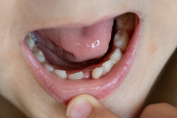 A close-up of a child's mouth with a wobbly baby tooth. 

