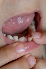 A close-up of a child's mouth with a wobbly baby tooth. 

