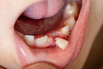 A close-up of a child's mouth with a wobbly baby tooth. 
