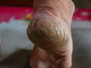 closeup Dry and Cracked Heels. Eczema. Psoriasis. Diabetes mellitus or hypothyroidism