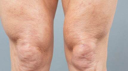 Wrinkled skin on both knees with visible texture and natural folds, showing detailed close up of human leg skin against plain background, highlighting natural aging and skin condition