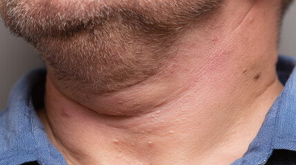 Obraz premium Close up of male neck with skin tags and slight redness showing natural skin texture and facial hair stubble, highlighting common skin condition in adult man wearing blue shirt