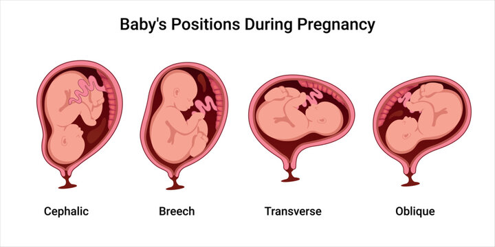 Different baby positions in the uterus during pregnancy. Anterior, Posterior, Cephalic, Breech, Transverse, Oblique positions. Pathology. Detailed medical vector illustration.