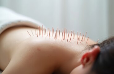 Close-up photo of person back undergoing acupuncture treatment. Thin needles inserted into skin. Alternative medicine therapy for pain relief and wellness. Focus on health and holistic approach.