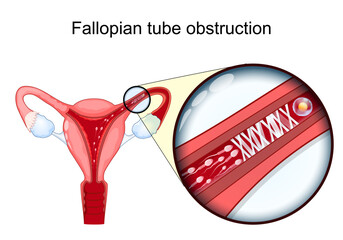 Fallopian tube obstruction. Female infertility