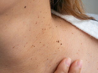 Close up detail of the bare skin on an Asian woman neck with scattered moles and freckles. Sun...
