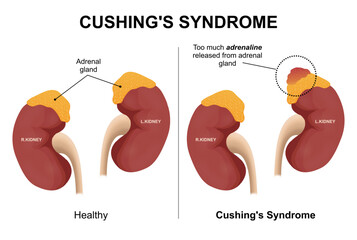 Cushing's syndrome kidney disease illustration