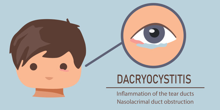 Vector illustration of dacryocystitis showing child with inflamed tear duct, swollen eye and blocked nasolacrimal system