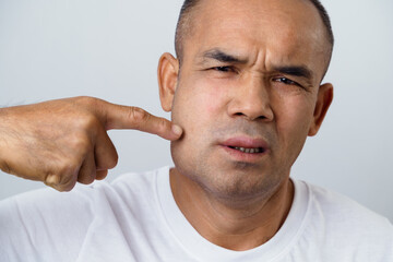 Man has facial swelling due to an allergic reaction to triggers such as insect bites, food