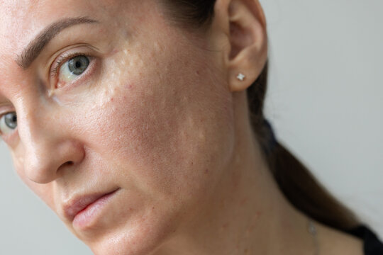 Papules on the face of a woman after biorevitalization treatment. 