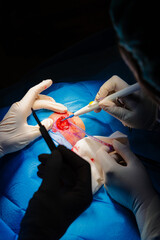 Dermatologic surgery in the operating room. Coagulation of the lesion and fluid aspiration