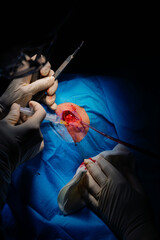 Dermatologic surgery in the operating room. Injection of anesthesia into the lesion