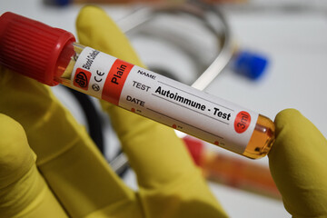 Autoimmune - Test with blood sample. Top view isolated on office desk. Healthcare or Medical concept