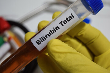 Bilirubin - Test with blood sample. Top view isolated on office desk. Healthcare or Medical concept