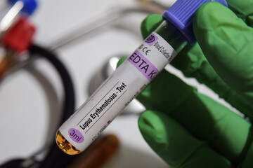 Lupus Erythematosus - Test with blood sample. Top view isolated on office desk. Healthcare or Medical concept